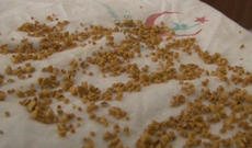 Öd kisəsindən 1050 ədəd daş çıxarıldı - VİDEO