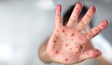 Okeaniyada qızılca epidemiyası - 100-ə yaxın ölü