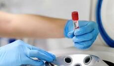 Azərbaycanda koronavirus  infeksiyasına 332 yeni yoluxma faktı qeydə alınıb