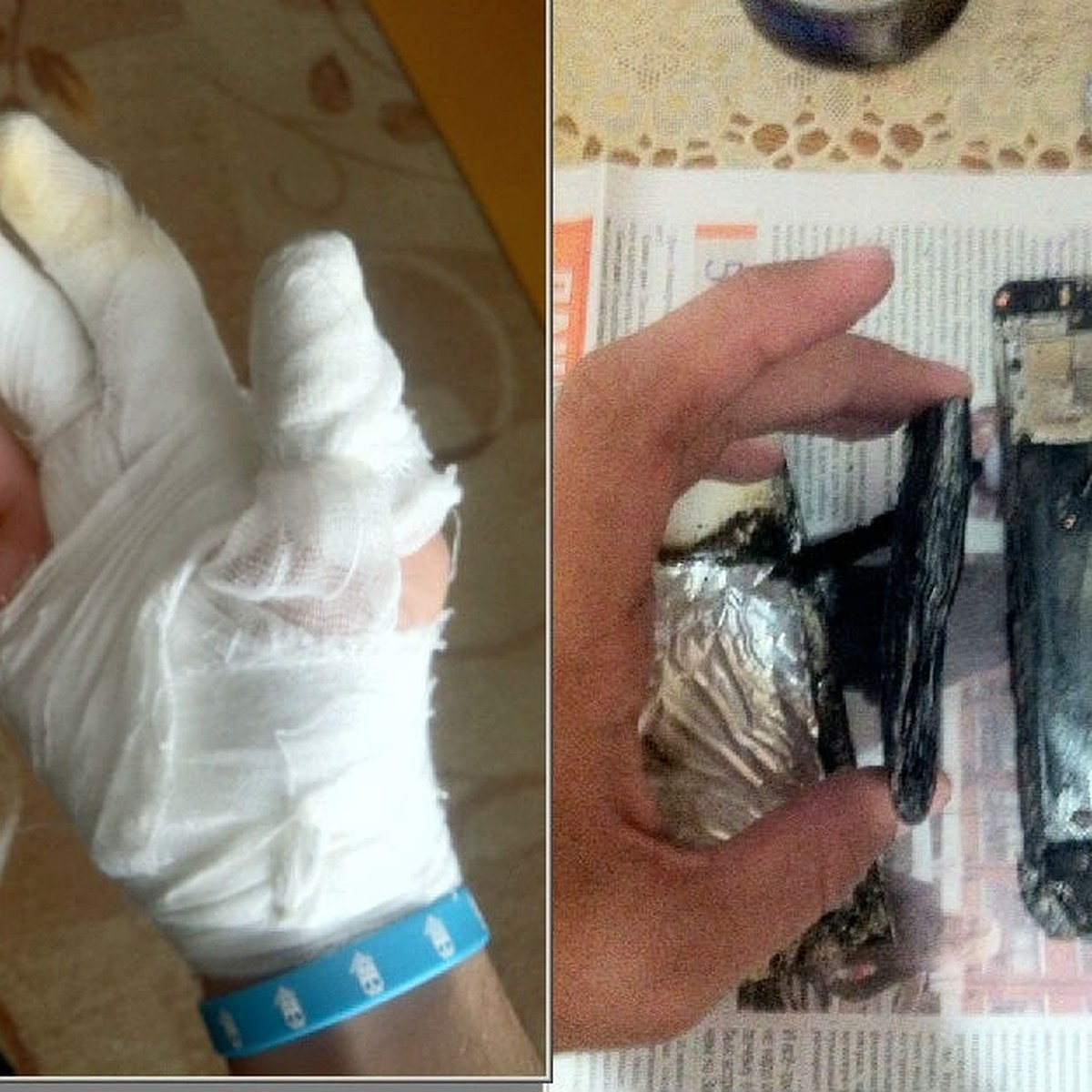Birinci sinif şagirdinin telefonu partladığına görə o, xəstəxanaya yerləşdirilib