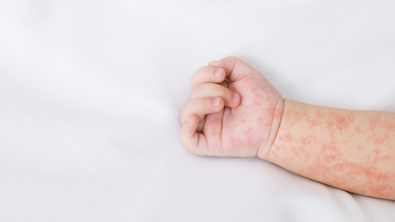 Qazaxıstanda qızılca epidemiyası tuğyan edir: 29 uşaq reanimasiyadadır