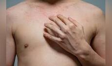 Monqolustanda qızılca xəstələri təcrid olunduqdan sonra yeni yoluxma halları aşkarlanmayıb