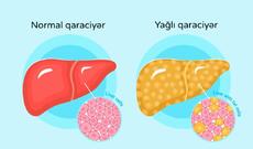Hormon Qaraciyər Piylənməsi Xəstəliyini Geri qaytara bilər