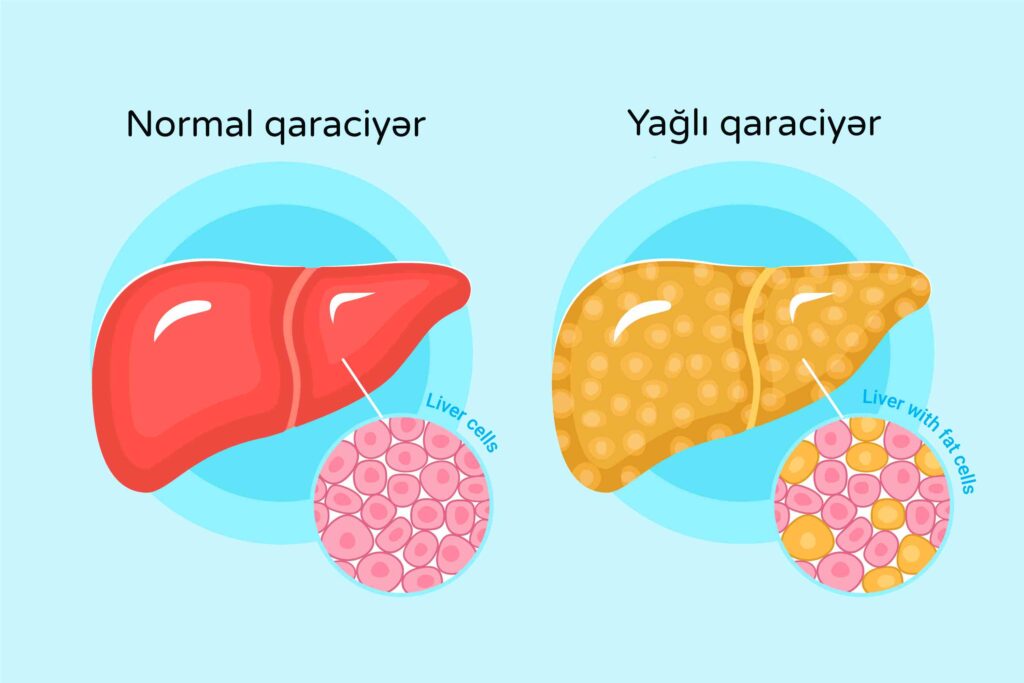 Hormon Qaraciyər Piylənməsi Xəstəliyini Geri qaytara bilər