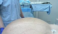 Rusiyada həkimlər kişidən 60 kiloqramlıq şiş çıxarıblar