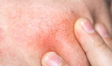 Dəri qaşınmasının gözlənilməyən səbəbləri açıqlanıb