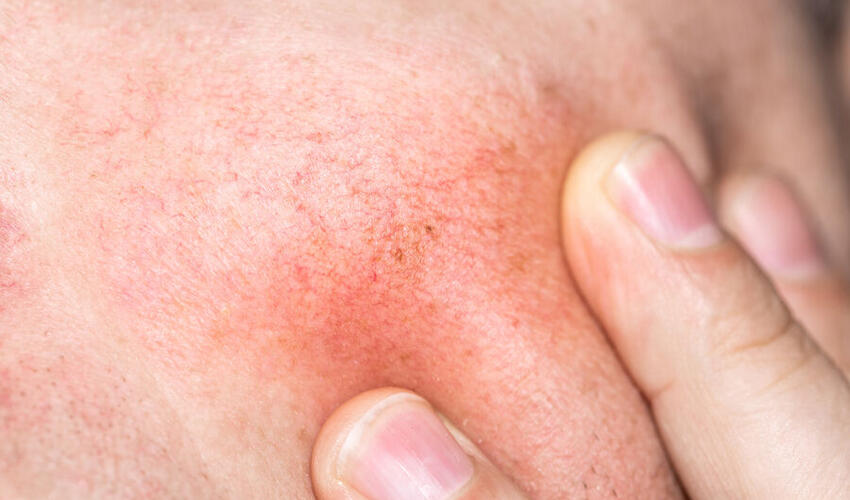 Dəri qaşınmasının gözlənilməyən səbəbləri açıqlanıb