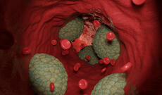 "Pis" xolesterinin səviyyəsini bir prosedurla azaltmaq üçün üsul tapılıb