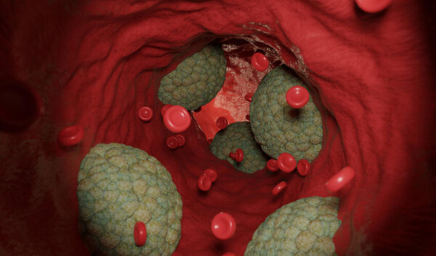 "Pis" xolesterinin səviyyəsini bir prosedurla azaltmaq üçün üsul tapılıb