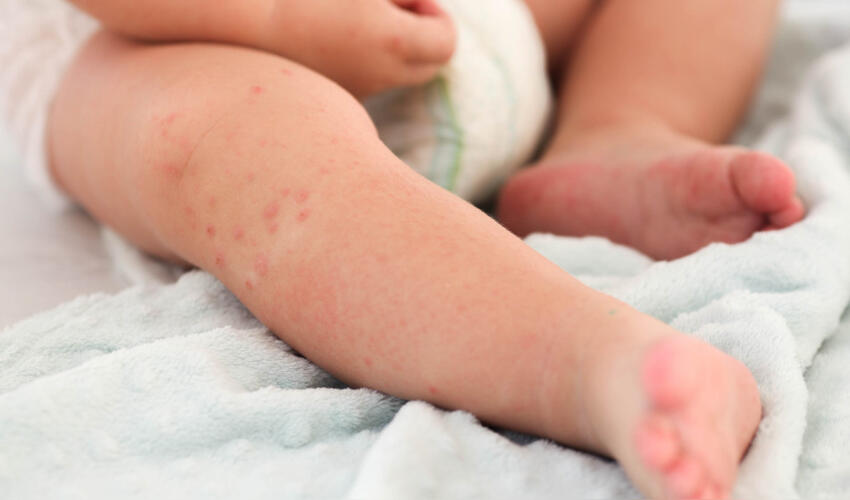 ABŞ-da qızılca kütləvi şəkildə yayılmaqda davam edir