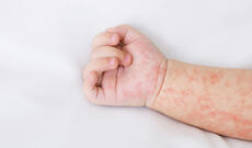 Banqladeşdə qızılca epidemiyası 459 uşağın ölümünə səbəb olub
