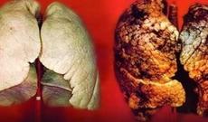 Xərçənglə mübarizədə daha bir addım atıldı