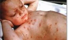 Bir həftədə 750 uşaq qızılcaya yoluxdu