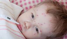 Ukraynada qızılca xəstəliyinin artması təşvişə səbəb olub