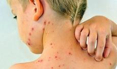 Dünyada qızılcadan ölənlərin sayı artır