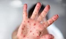 Ukraynada 54 mindən artıq insan qızılca xəstəliyinə tutulub