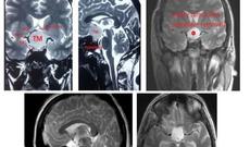 Unikal neyrocərrahiyyə əməliyyatı icra edilib